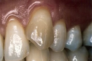 Gingival graft for root coverage after